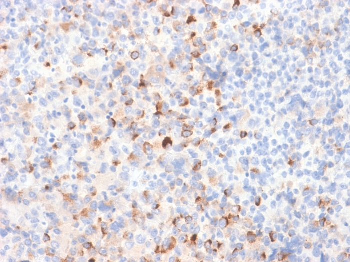 IHC-P analysis of human melanoma tissue section using GTX02735 Tyrosinase antibody [TYR/2024R].