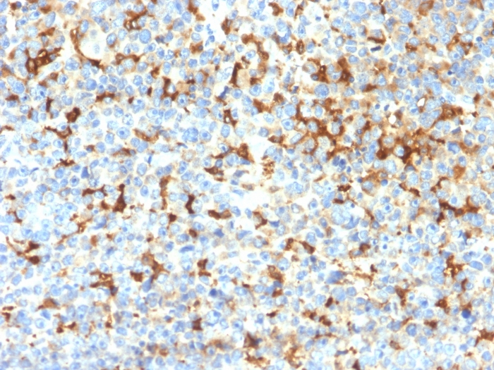 IHC-P analysis of human melanoma tissue section using GTX02736 TRP1 antibody [TYRP1/2340R].