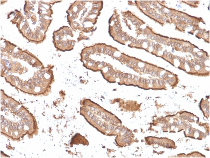 IHC-P analysis of human small intestinal carcinoma section using GTX02738 Villin antibody [rVIL1/1325].