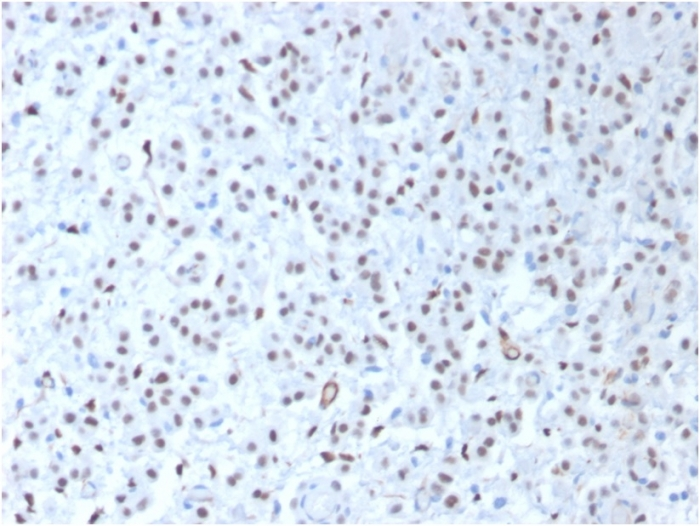 IHC-P analysis of human mesothelioma section using GTX02743 Wilms Tumor 1 antibody [WT1/1434R].