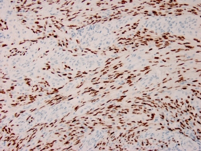 IHC-P analysis of human Kaposis sarcoma section using GTX02772 KSHV ORF73 antibody [HHV8/3633R].