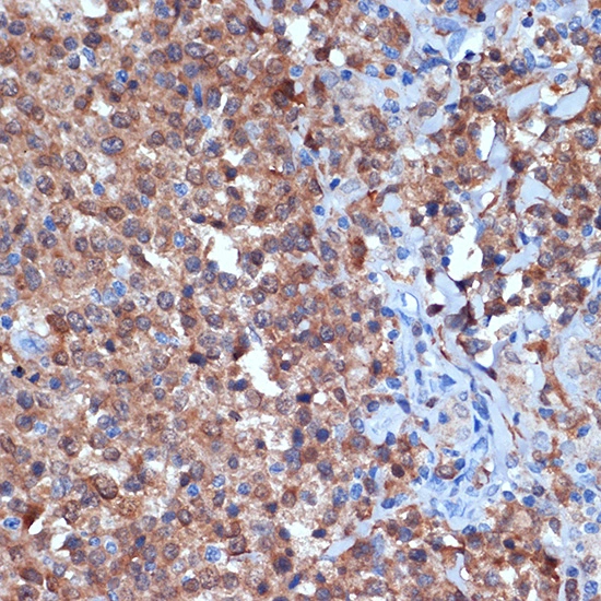 IHC-P analysis of human thyroid cancer section using GTX02829 PKC delta antibody [GT1232]. Dilution : 1:100