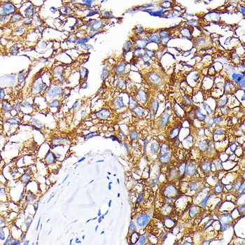 IHC-P analysis of human liver cancer section using GTX02830 Leptin Receptor antibody [GT1233]. Dilution : 1:100