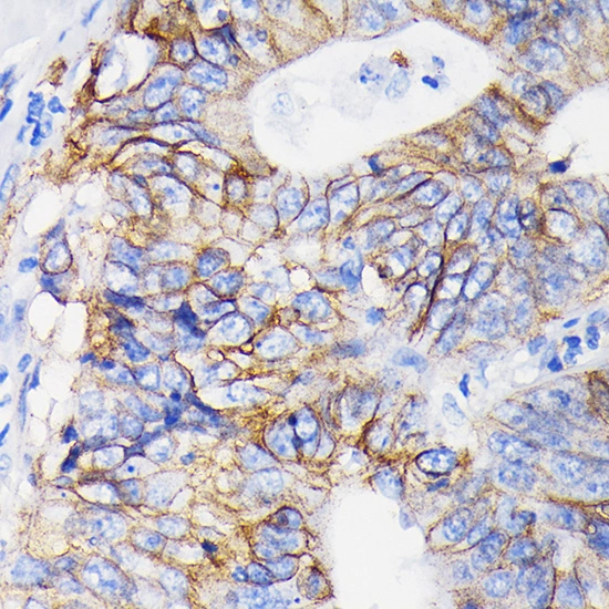 IHC-P analysis of human colon carcinoma section using GTX02835 Integrin alpha 2 antibody [GT1238]. Dilution : 1:100