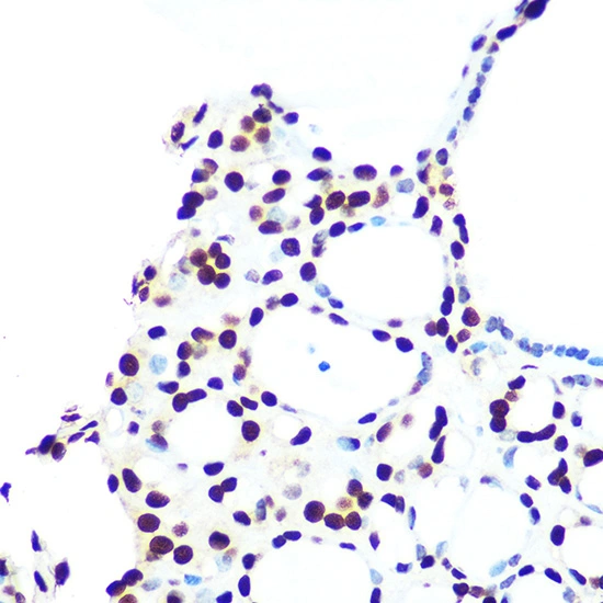IHC-P analysis of human thyroid cancer section using GTX02839 hnRNP U antibody [GT1242]. Dilution : 1:100