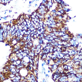 IHC-P analysis of human colon carcinoma section using GTX02847 C1qBP antibody [GT1250]. Dilution : 1:100
