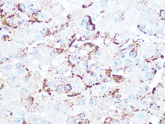 IHC-P analysis of human liver cancer section using GTX02849 Cathepsin L/V/K/H antibody [GT1252]. Dilution : 1:100