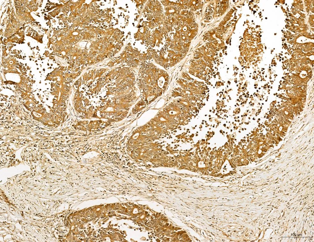 IHC-P analysis of human colorectal cancer tissue using GTX02887 LASS2 Antibody. Antigen retrieval : Heat mediated antigen retrieval step in citrate buffer was performed Dilution : 1:100