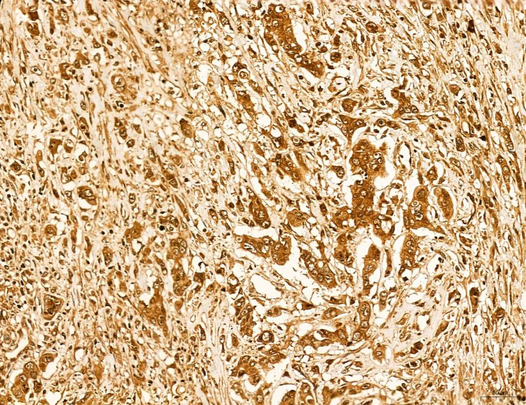 IHC-P analysis of human gastric cancer tissue using GTX02887 LASS2 Antibody. Antigen retrieval : Heat mediated antigen retrieval step in citrate buffer was performed Dilution : 1:100