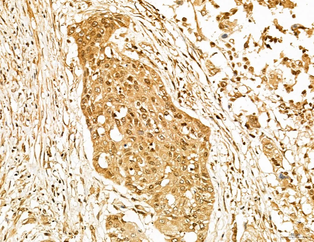 IHC-P analysis of human esophageal cancer tissue using GTX02887 LASS2 Antibody. Antigen retrieval : Heat mediated antigen retrieval step in citrate buffer was performed Dilution : 1:100