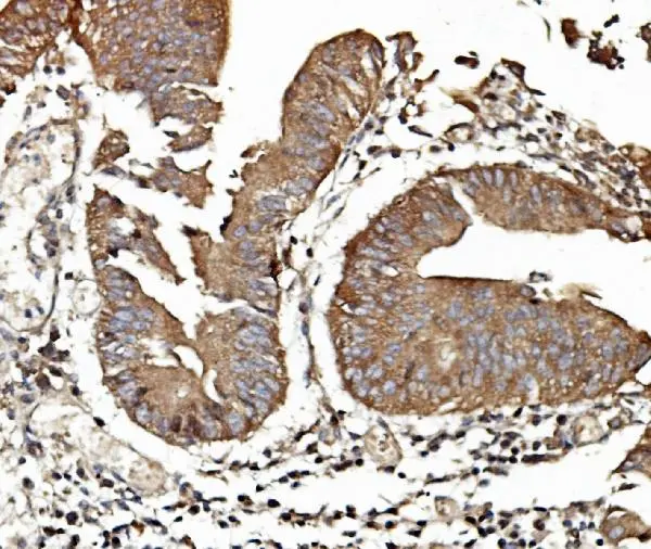 IHC-P analysis of human rectal cancer tissue using GTX02891 TAB2 antibody. Antigen retireval : Heat mediated antigen retrieval was performed in EDTA buffer (pH8.0, epitope retrieval solution) Dilution : 2microg/ml