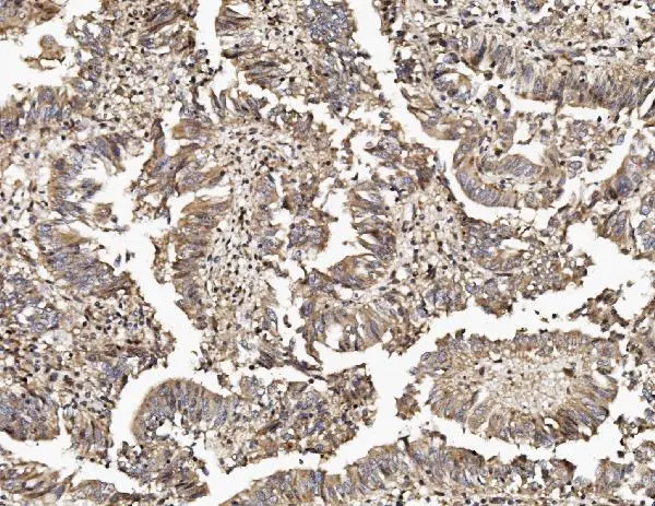 IHC-P analysis of human rectal cancer tissue using GTX02891 TAB2 antibody. Antigen retireval : Heat mediated antigen retrieval was performed in EDTA buffer (pH8.0, epitope retrieval solution) Dilution : 2microg/ml