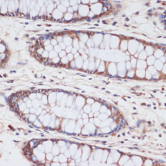 IHC-P analysis of human colon tissue using GTX03119 CDKN2A / p16INK4a antibody. Dilution : 1:100