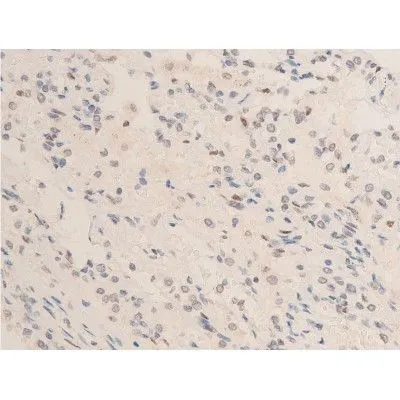 IHC-P analysis of human TB tissue using GTX03351 Chk2 (phospho Thr68) antibody. Antigen retireval : heat mediated antigen retrieval step in citrate buffer was performed. Dilution : 1:100