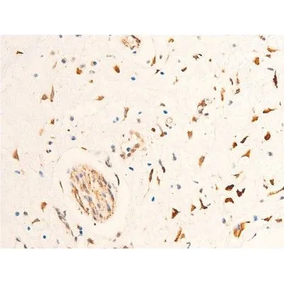 IHC-P analysis of human glioma tissue using GTX03351 Chk2 (phospho Thr68) antibody. Antigen retireval : heat mediated antigen retrieval step in citrate buffer was performed. Dilution : 1:100