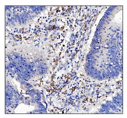 IHC-P analysis of human rectal cancer tissue using GTX03379 CD16a antibody. Antigen retireval : Heat mediated antigen retrieval was performed in EDTA buffer (pH 8.0, epitope retrieval solution). Dilution : 2 microg/ml