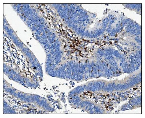 IHC-P analysis of human rectal cancer tissue using GTX03379 CD16a antibody. Antigen retireval : Heat mediated antigen retrieval was performed in EDTA buffer (pH 8.0, epitope retrieval solution). Dilution : 2 microg/ml