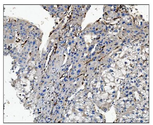 IHC-P analysis of human liver cancer tissue using GTX03379 CD16a antibody. Antigen retireval : Heat mediated antigen retrieval was performed in EDTA buffer (pH 8.0, epitope retrieval solution). Dilution : 2 microg/ml