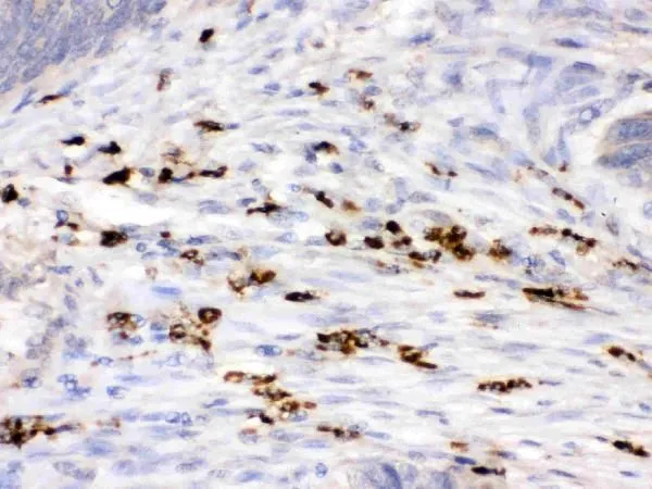 IHC-P analysis of human intestinal cancer tissue using GTX03467 Lysozyme antibody. Antigen retireval : Heat mediated antigen retrieval was performed in EDTA buffer (pH 8.0, epitope retrieval solution). Dilution : 1 microg/ml IHC-P analysis of human intestinal cancer tissue using GTX03467 Lysozyme antibody. Antigen retireval : Heat mediated antigen retrieval was performed in EDTA buffer (pH 8.0, epitope retrieval solution). Dilution : 1 microg/ml