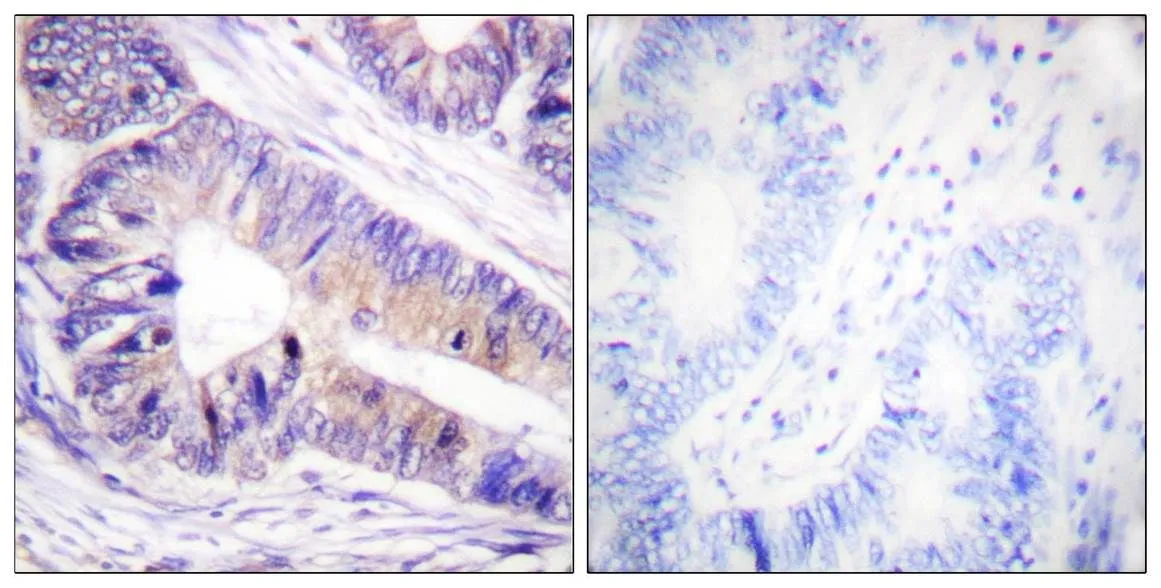 IHC-P analysis of human colon carcinoma tissue using GTX03589 14-3-3 zeta antibody. The picture on the right is blocked with the synthesized peptide.