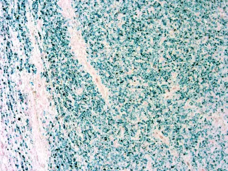 IHC-P analysis of human melanoma tissue using GTX12502 Melanoma antibody [PNL2] with GTX03614 10X Rapid Histo-Sealer.