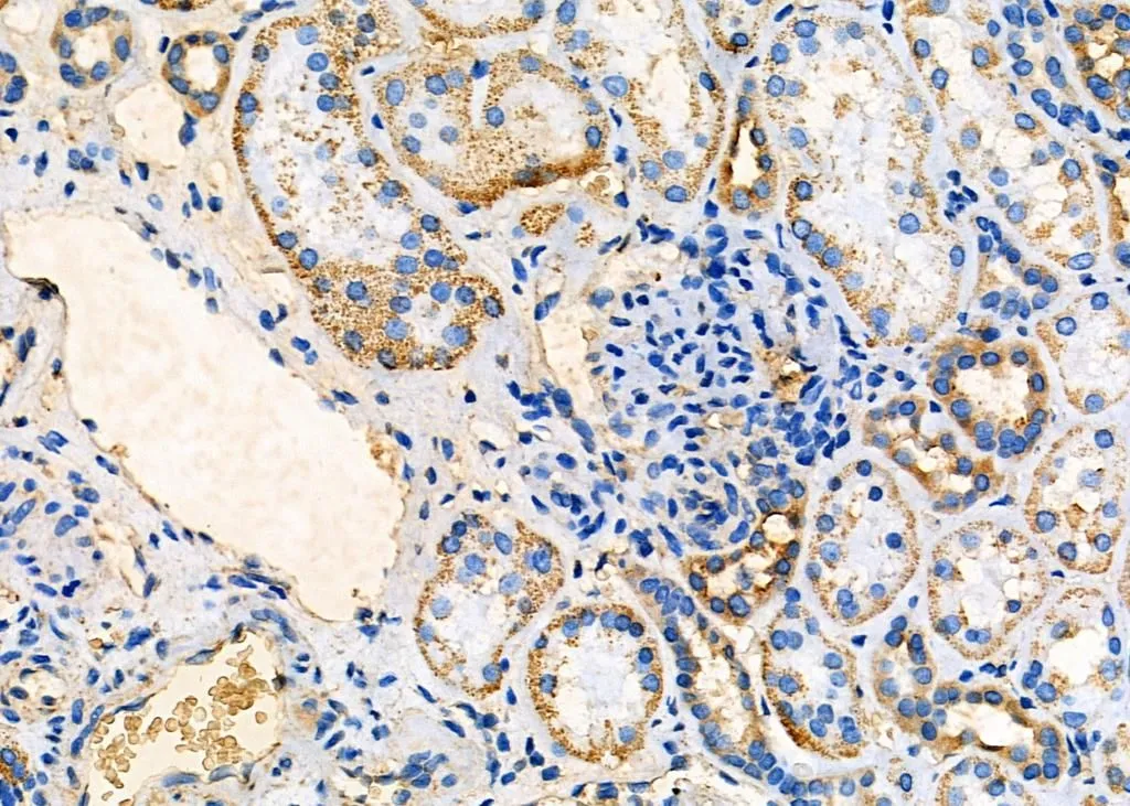 IHC-P analysis of human kidney cancer tissue using GTX03690 ARRDC1 antibody. Dilution : 1:100 Antigen retrieval : Heat mediated antigen retrieval step in citrate buffer was performed IHC-P analysis of human kidney cancer tissue using GTX03690 ARRDC1 antibody. Dilution : 1:100 Antigen retrieval : Heat mediated antigen retrieval step in citrate buffer was performed