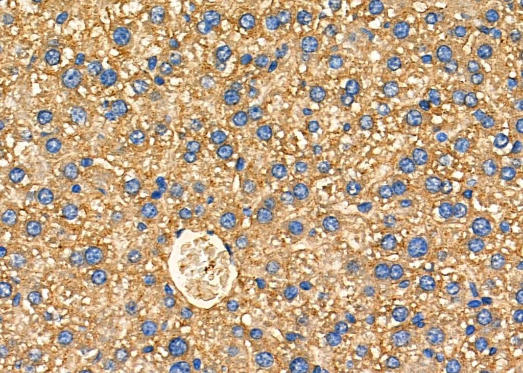 IHC-P analysis of mouse liver cancer tissue using GTX03690 ARRDC1 antibody. Dilution : 1:100 Antigen retrieval : Heat mediated antigen retrieval step in citrate buffer was performed
