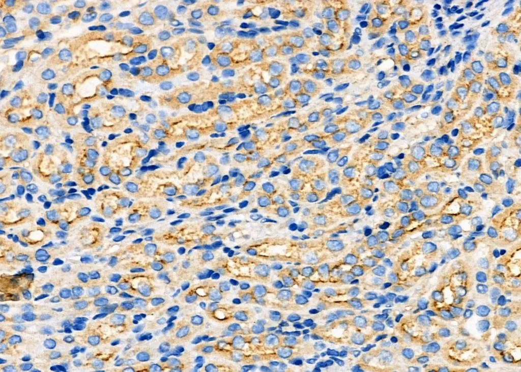 IHC-P analysis of mouse kidney cancer tissue using GTX03690 ARRDC1 antibody. Dilution : 1:100 Antigen retrieval : Heat mediated antigen retrieval step in citrate buffer was performed