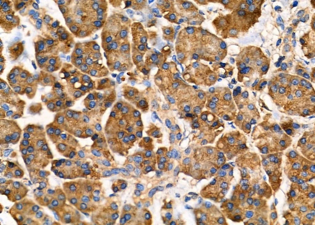 IHC-P analysis of human pancreatic cancer tissue using GTX03690 ARRDC1 antibody. Dilution : 1:100 Antigen retrieval : Heat mediated antigen retrieval step in citrate buffer was performed