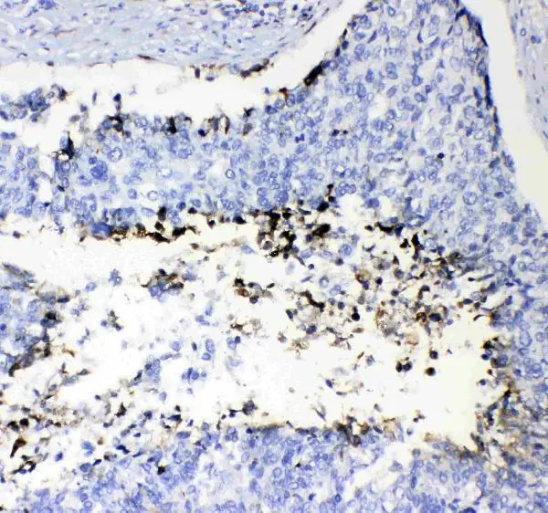 IHC-P analysis of human lung cancer tissue using GTX03694 Prothrombin antibody. Dilution : 1 microg/ml Antigen retrieval : Heat mediated antigen retrieval was performed in citrate buffer (pH6, epitope retrieval solution) for 20 mins