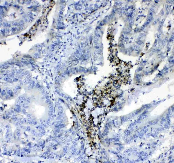 IHC-P analysis of human colon cancer tissue using GTX03694 Prothrombin antibody. Dilution : 1 microg/ml Antigen retrieval : Heat mediated antigen retrieval was performed in citrate buffer (pH6, epitope retrieval solution) for 20 mins