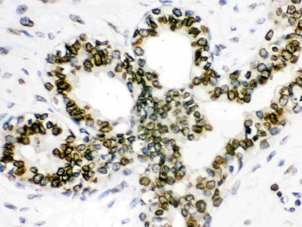 IHC-P analysis of human mammary cancer tissue using GTX03695 Lamin B1 antibody. Dilution : 1 microg/ml Antigen retrieval : Heat mediated antigen retrieval was performed in citrate buffer (pH6, epitope retrieval solution) for 20 mins