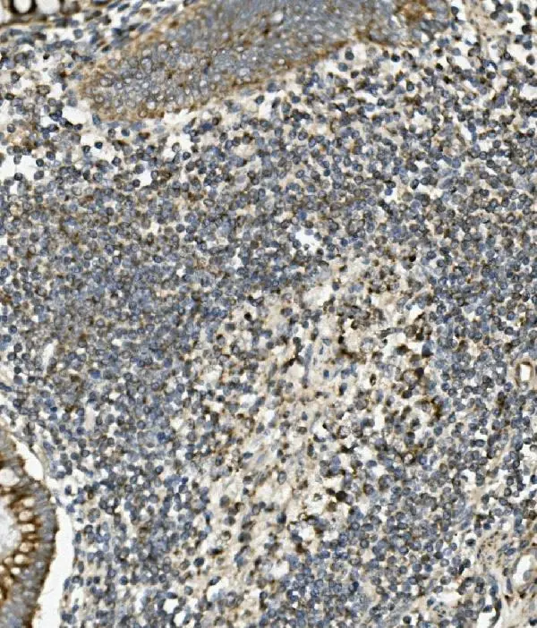 IHC-P analysis of human rectal cancer tissue using GTX03696 SGK1 antibody. Dilution : 1 microg/ml Antigen retrieval : Heat mediated antigen retrieval was performed in EDTA buffer (pH8.0, epitope retrieval solution)