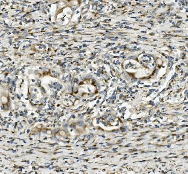 IHC-P analysis of human rectal cancer tissue using GTX03696 SGK1 antibody. Dilution : 1 microg/ml Antigen retrieval : Heat mediated antigen retrieval was performed in EDTA buffer (pH8.0, epitope retrieval solution)