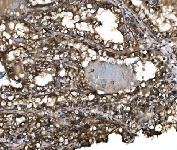 IHC-P analysis of human renal clear cell carcinoma tissue using GTX03712 Claudin 3 antibody. Antigen retrieval : Heat mediated antigen retrieval was performed in EDTA buffer (pH8.0, epitope retrieval solution) Dilution : 2microg/ml