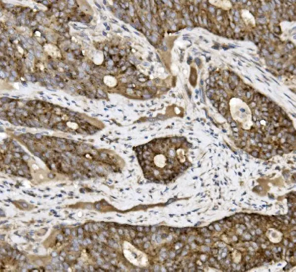 IHC-P analysis of human gallbladder adenocarcinoma tissue using GTX03712 Claudin 3 antibody. Antigen retrieval : Heat mediated antigen retrieval was performed in EDTA buffer (pH8.0, epitope retrieval solution) Dilution : 2microg/ml