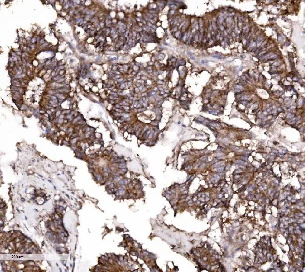 IHC-P analysis of human colonic adenocarcinoma tissue using GTX03712 Claudin 3 antibody. Antigen retrieval : Heat mediated antigen retrieval was performed in EDTA buffer (pH8.0, epitope retrieval solution) Dilution : 2microg/ml