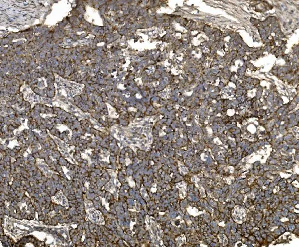 IHC-P analysis of human ovarian serous adenocarcinoma tissue using GTX03712 Claudin 3 antibody. Antigen retrieval : Heat mediated antigen retrieval was performed in EDTA buffer (pH8.0, epitope retrieval solution) Dilution : 2microg/ml
