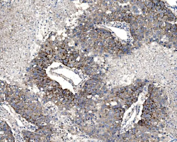 IHC-P analysis of human liver cancer tissue using GTX03712 Claudin 3 antibody. Antigen retrieval : Heat mediated antigen retrieval was performed in EDTA buffer (pH8.0, epitope retrieval solution) Dilution : 2microg/ml