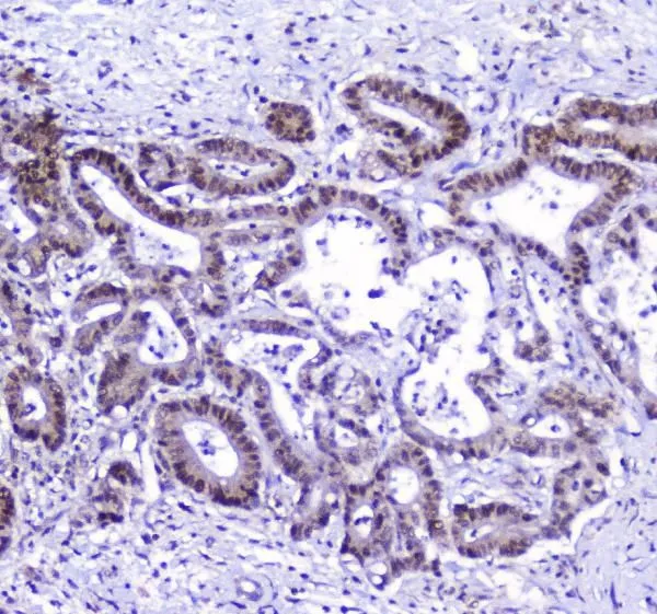 IHC-P analysis of human cholangiocarcinoma tissue using GTX03719 AHR antibody. Antigen retrieval : Heat mediated antigen retrieval was performed in citrate buffer (pH6, epitope retrieval solution) for 20 mins Dilution : 2microg/ml