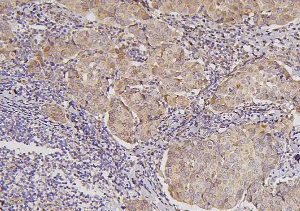IHC-P analysis of human mammary cancer tissue using GTX03785 B7-H4 antibody. Antigen retrieval : Heat mediated antigen retrieval was performed in EDTA buffer (pH8.0, epitope retrieval solution) Dilution : 1microg/ml