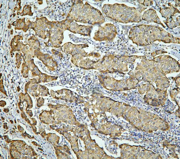 IHC-P analysis of human mammary cancer tissue using GTX03806 LONP1 antibody. Antigen retrieval : Heat mediated antigen retrieval was performed in citrate buffer (pH6, epitope retrieval solution) for 20 mins Dilution : 1microg/mL