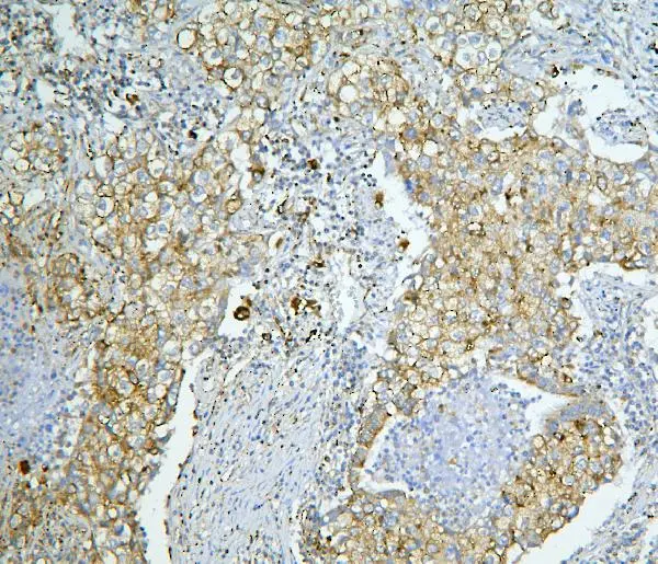 IHC-P analysis of human lung cancer tissue using GTX03806 LONP1 antibody. Antigen retrieval : Heat mediated antigen retrieval was performed in citrate buffer (pH6, epitope retrieval solution) for 20 mins Dilution : 1microg/mL