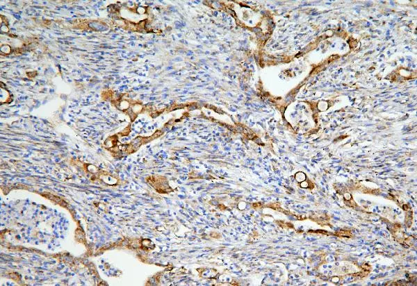 IHC-P analysis of human rectal cancer tissue using GTX03806 LONP1 antibody. Antigen retrieval : Heat mediated antigen retrieval was performed in citrate buffer (pH6, epitope retrieval solution) for 20 mins Dilution : 1microg/mL