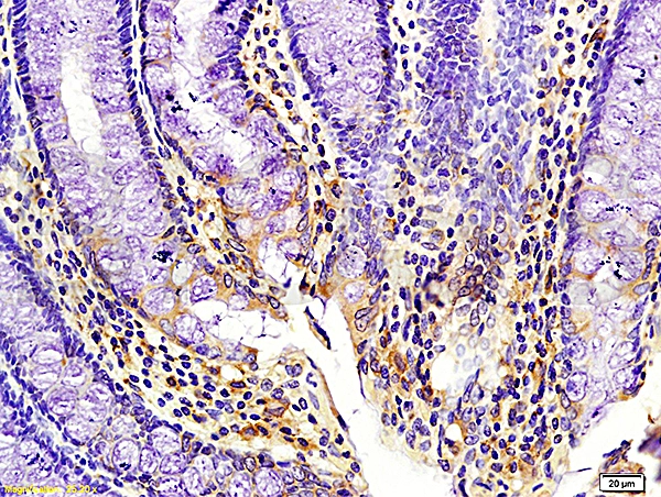 IHC-P analysis of human colon cancer tissue using GTX04074 Kiss1 antibody. Dilution : 1:200 IHC-P analysis of human colon cancer tissue using GTX04074 Kiss1 antibody. Dilution : 1:200