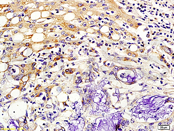IHC-P analysis of human colon cancer tissue using GTX04074 Kiss1 antibody. Dilution : 1:200