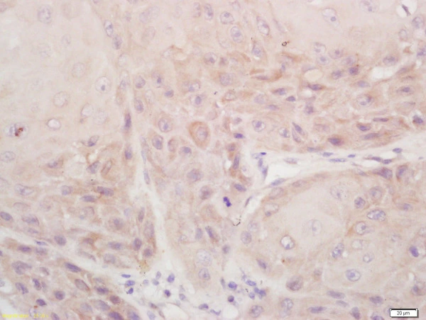 IHC-P analysis of human laryngocarcinoma tissue using GTX04076 DSPP antibody. Dilution : 1:200 IHC-P analysis of human laryngocarcinoma tissue using GTX04076 DSPP antibody. Dilution : 1:200