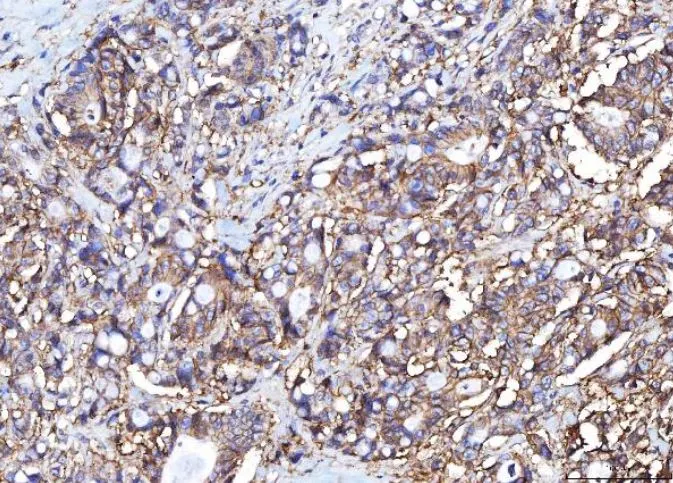 IHC-P analysis of human colorectal adenocarcinoma tissue using GTX04249 CD155 antibody [5I13D1]. Antigen retrieval : Heat mediated antigen retrieval was performed in EDTA buffer (pH 8.0, epitope retrieval solution) Dilution : 2 microg/mL