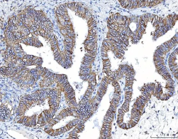 IHC-P analysis of human endometrial cancer tissue using GTX04249 CD155 antibody [5I13D1]. Antigen retrieval : Heat mediated antigen retrieval was performed in EDTA buffer (pH 8.0, epitope retrieval solution) Dilution : 2 microg/mL