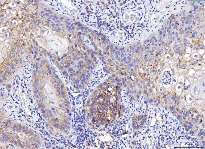 IHC-P analysis of human laryngeal squamous cell carcinoma tissue using GTX04249 CD155 antibody [5I13D1]. Antigen retrieval : Heat mediated antigen retrieval was performed in EDTA buffer (pH 8.0, epitope retrieval solution) Dilution : 2 microg/mL